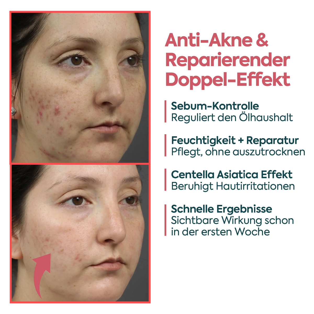 Clasy Care Perfekte Wirkung gegen Akne & Pickel – FACEUPSKIN® für unreine Haut 40 ml