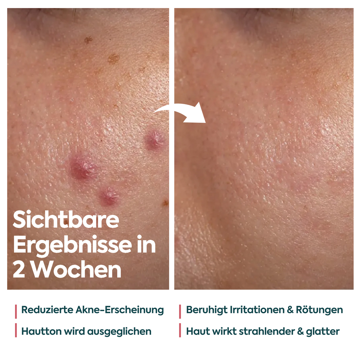 Clasy Care Perfekte Wirkung gegen Akne & Pickel – FACEUPSKIN® für unreine Haut 40 ml
