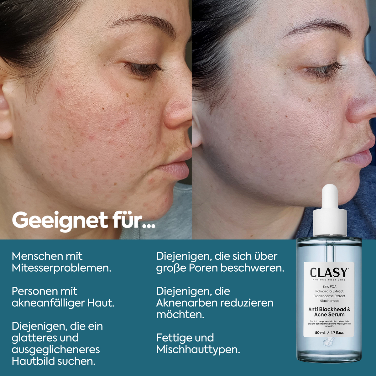 Clasy Care Anti-Mitesser & Akne Serum – 50 ml